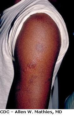 Picture from the CDC of Viral Skin Infection - Herpes gladiatorum, the site is the arm