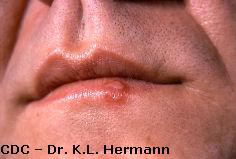 Herpes simplex virus type 1 (HSV-1) on lip