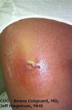 MRSA infection on thigh
