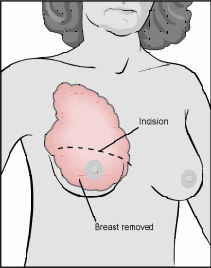 Diagram of Total Mastectomy