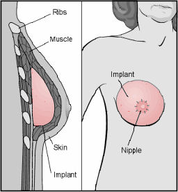 Breast Reconstruction with Implants