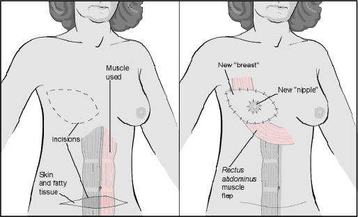 Breast Reconstruction with Tissue Flaps