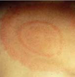Example of Eyrtheman Migrans Rash - Picture 1