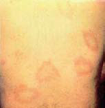 Example of Eyrtheman Migrans Rash - Picture 2
