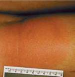 Example of Eyrtheman Migrans Rash - Picture 3